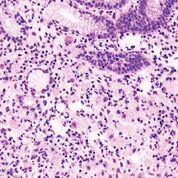 Imagen: Una histopatología del adenocarcinoma gástrico que representa una variante de células en anillo de sello identificada en una muestra de biopsia endoscópica (Fotografía cortesía del KGH).