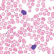 Imagen: Frotis de sangre de un paciente con linfocitosis monoclonal de células B. Los dos linfocitos atípicos están maduros con un borde pequeño de citoplasma basófilo y cromatina aglomerada o agrietada (Fotografía cortesía de Elizabeth Courville, MD).