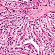 Imagen: Una histopatología del carcinoma de células renales papilares de células claras (Fotografía cortesía de Nephron).