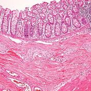 Imagen: Una histopatología de la enfermedad de Hirschsprung, caracterizada por la ausencia de células ganglionares parasimpáticas en los plexos tanto submucosos como mientéricos en el tracto gastrointestinal distal (Fotografía cortesía del Dr. Dharam Ramnani).