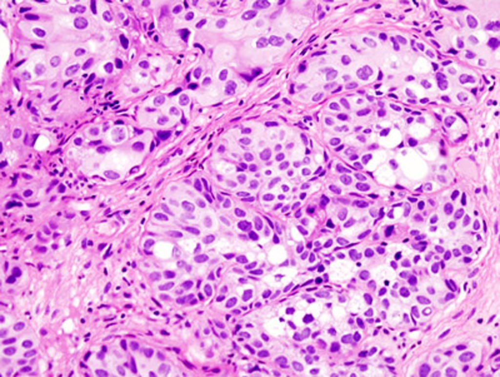 Imagen: Una microfotografía del carcinoma urotelial de la vejiga urinaria (Fotografía cortesía de la facultad de medicina Baylor).