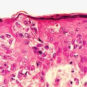 Imagen: Una histopatología del cáncer de próstata resistente a la castración (Fotografía cortesía de Andrew J. Armstrong, MD, ScM).