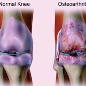 Imagen: La osteoartrosis de rodilla, también conocida como enfermedad articular degenerativa, suele deberse al desgaste y la pérdida progresiva del cartílago articular (Fotografía cortesía de Bruce Blaus).