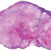 Imagen: Un ganglio linfático con reemplazo casi completo por un melanoma metastásico. El pigmento marrón es el depósito focal de la melanina (Fotografía cortesía de Gabriel Caponetti, MD).