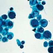 Imagen: El virus BK (BKV) es un poliomavirus humano ubicuo que causa cistitis hemorrágica en los pacientes con trasplante de células madre hematopoyéticas y nefropatía en los receptores de trasplante renal. Las células uroteliales poco cohesivas poseen núcleos amorfos y difusos, indicativos de infección viral por BK (Fotografía cortesía de Pathos223).