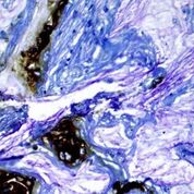 Imagen: En esta microfotografía, las áreas marrones se colorearon para un biomarcador en el tejido de un paciente que desarrolló cáncer de páncreas a partir de un quiste (Fotografía cortesía del Dr. Koushik Das, Universidad de Washington).