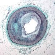 Imagen: Una microfotografía de una arteria coronaria con la forma más común de enfermedad arterial coronaria (aterosclerosis) y un estrechamiento luminal marcado (Fotografía cortesía de Wikimedia Commons).