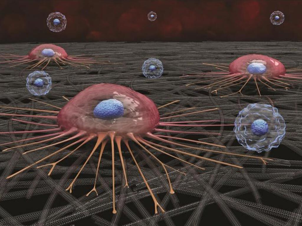 Imagen: Una célula cancerosa circulante (rosa) se adhiere a la superficie de nanotubos de carbono; los glóbulos blancos (azul) no se adhieren y luego se eliminan (Fotografía cortesía de Curtis Sayers).