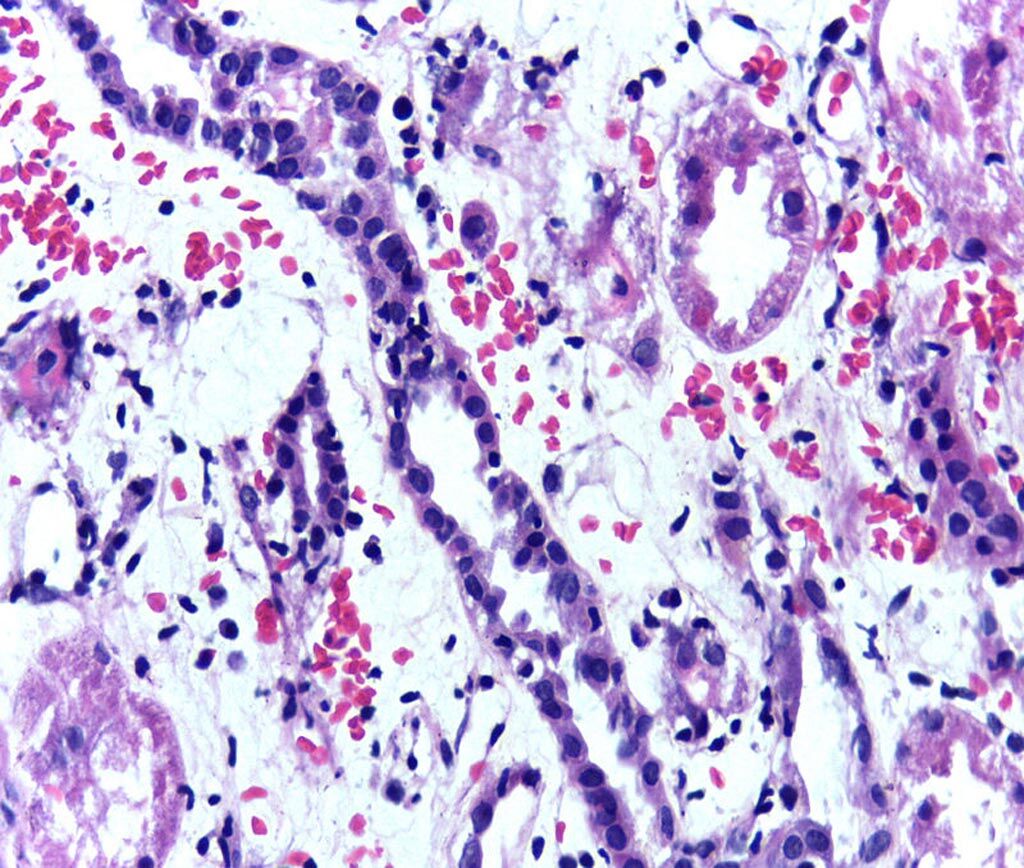 Imagen: Presencia de linfocitos dentro del epitelio tubular, característico del rechazo celular agudo de un injerto renal (Fotografía cortesía de Wikimedia Commons).