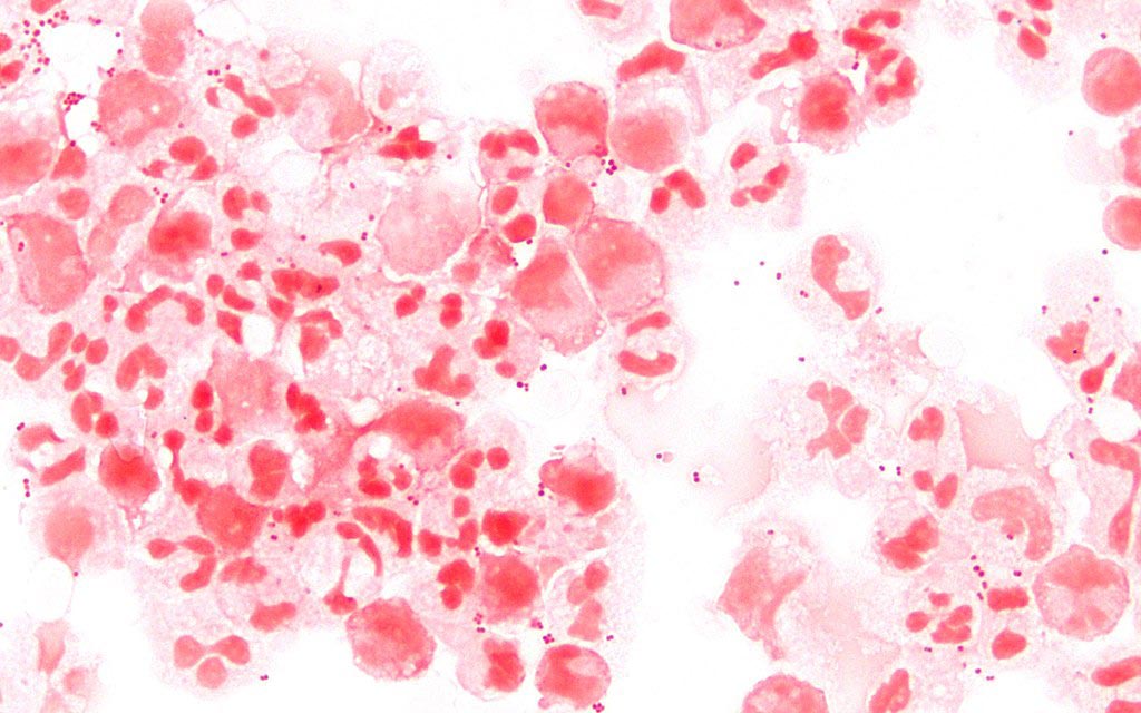 Una micrografía de Neisseria meningitidis en líquido cefalorraquídeo (LCR) observada mediante coloración de Gram a 1000 aumentos. La infección se podría prevenir mediante la vacunación (Fotografía cortesía de Wikimedia Commons).