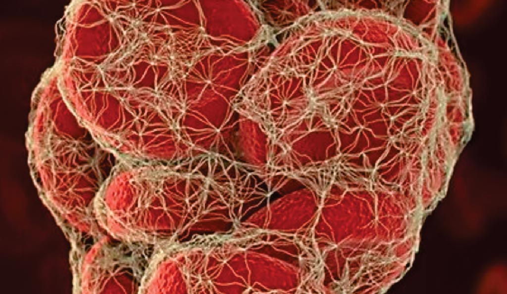 El riesgo de resultados tromboembólicos y de hemorragia después de los cánceres hematológicos es muy alto (Fotografía cortesía de la Universidad de Warwick).