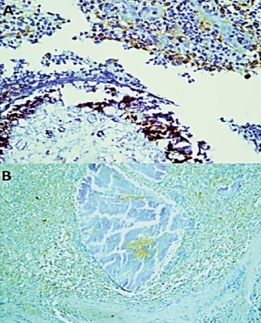 Imagen: Una expresión de IL-17A en una coloración inmunohistoquímica en (A) M. mycetomatis y (B) S. somaliensis. La coloración con IL-17A se observó como una tinción citoplásmica marrón en las células (Fotografía cortesía de la Universidad de Jartum).
