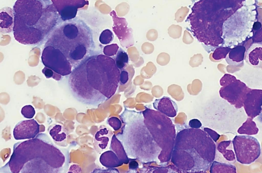 Aspirado de médula ósea de un paciente con leucemia mieloide asociada con el síndrome de Down. El frotis incluye la presencia de megacariocitos atípicos frecuentes. Los blastos están aumentados (11%). Al igual que en la sangre periférica, un subconjunto de los blastos tiene ampollas citoplasmáticas (Fotografía cortesía de Elizabeth L. Courville, MD).