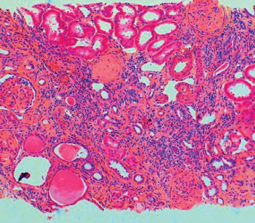 Una histopatología de la nefritis intersticial crónica en la enfermedad renal terminal. Hay cicatrices intersticiales difusas con un infiltrado mononuclear inespecífico (Fotografía cortesía de Agnes B. Fogo MD, Michael Kashgarian MD).