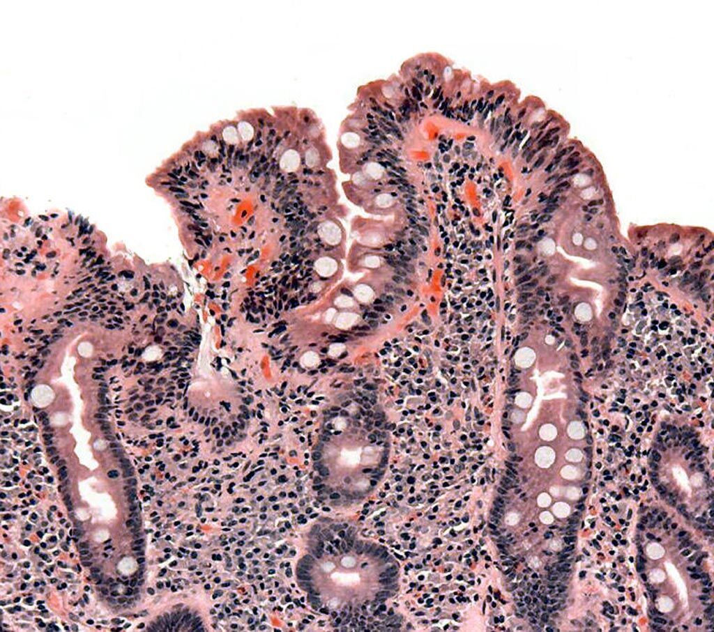 Imagen: Una biopsia de intestino delgado que muestra enfermedad celíaca manifestada por embotamiento de las vellosidades, la hipertrofia de las criptas y la infiltración linfocitaria de las criptas (Fotografía cortesía de Wikimedia Commons).