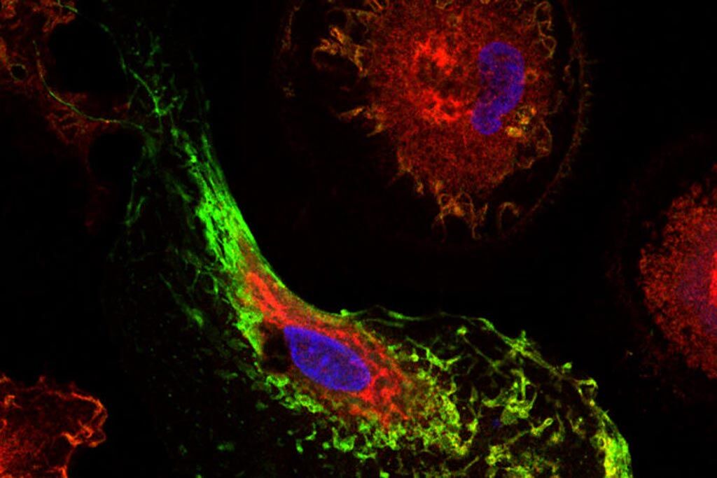Imagen: Un par de genes que influyen en el riesgo de la enfermedad de Alzheimer, MS4A4A y TREM2, afectan las células inmunes en el cerebro. Influyen en el riesgo de adquirir la enfermedad de Alzheimer al alterar los niveles de TREM2, una proteína (que se muestra teñida en rojo) que se cree que ayuda a las células de la microglía a eliminar del cerebro las cantidades excesivas de proteínas amiloides y tau del Alzheimer. La proteína MS4A4A se muestra teñida de verde (Fotografía cortesía de Fabia Filipello y Dennis Oakley, facultad de medicina de la Universidad de Washington).