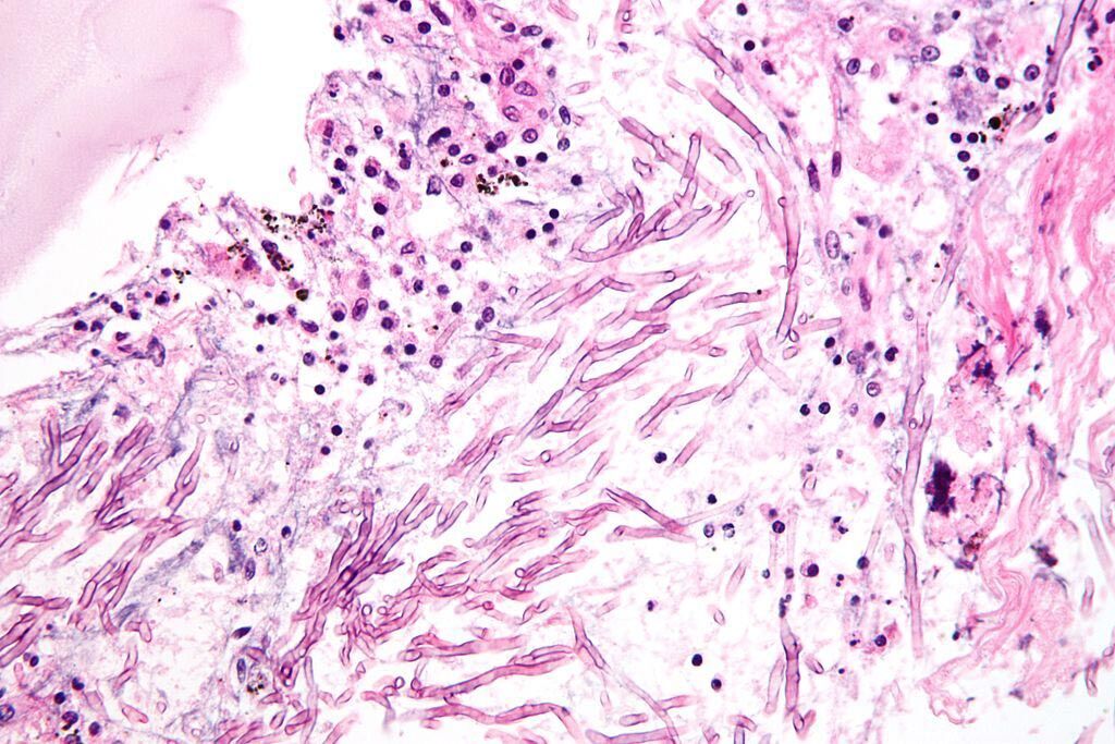 Imagen: Una microfotografía que muestra una micosis (aspergilosis). El Aspergillus (que es como un espagueti) se ve en el centro rodeado de células inflamatorias y detritos necróticos (Fotografía cortesía de Wikimedia Commons).