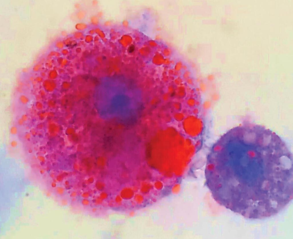 Imagen: Los macrófagos cargados de lípidos se encuentran en pacientes con enfermedades respiratorias relacionadas con el vapeo. Los lípidos aceitosos se ven de color rojo (Fotografía cortesía de Andrew Hansen, MD, Centro Médico del Valle del Jordán).