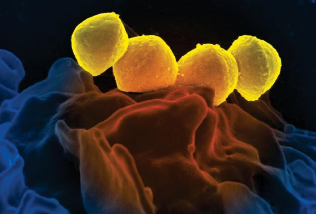 Imagen: Esta imagen microscópica electrónica de barrido, coloreada digitalmente (SEM) muestra cuatro bacterias Streptococcus del grupo A (GAS) de color amarillo, que se encuentran sobre la superficie de un glóbulo blanco humano (WBC), denominado neutrófilo (Fotografía cortesía del Instituto Nacional de Alergias y Enfermedades Infecciosas de los Estados Unidos).