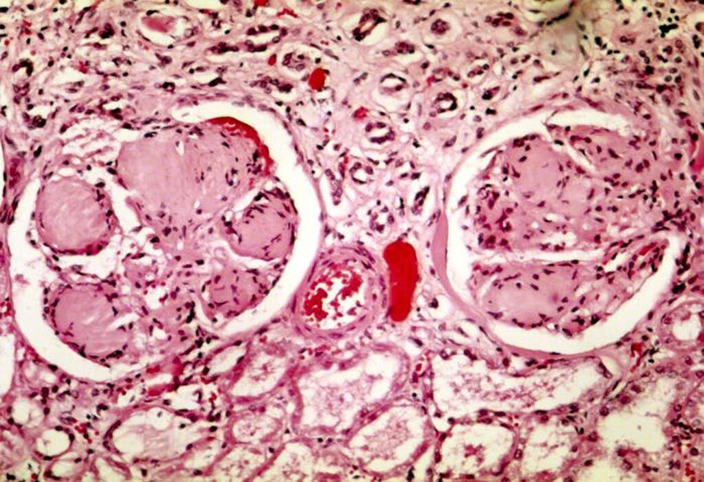 Imagen: Una microfotografía que muestra dos glomérulos en la enfermedad renal diabética: las áreas acelulares de color púrpura claro dentro de los mechones capilares son los depósitos destructivos de la matriz mesangial (Fotografía cortesía de Wikimedia Commons).