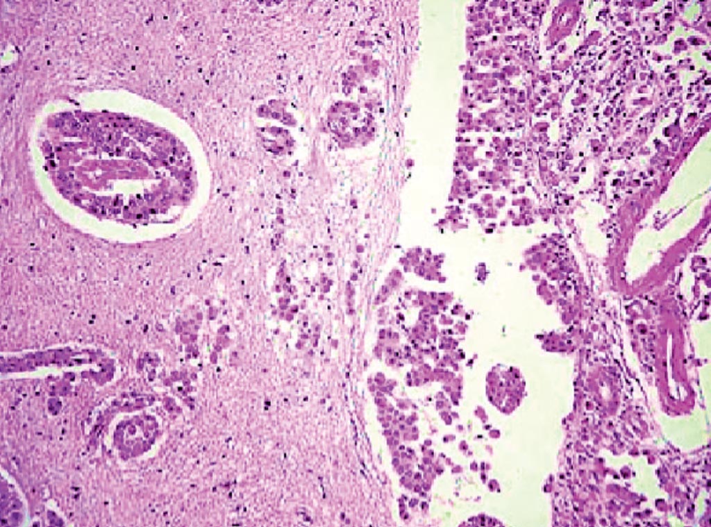 Imagen: Una histopatología de la carcinomatosis meníngea con infiltración de la materia gris del cerebro y las células malignas perivasculares (Fotografía cortesía de Zuzana Gdovinova).