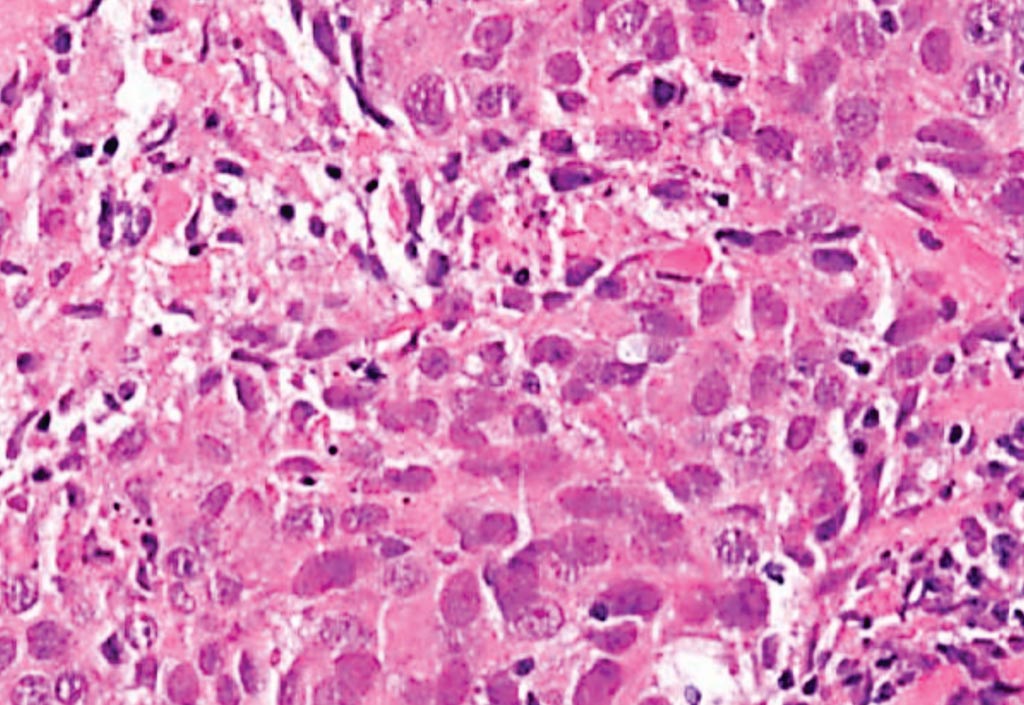 Imagen: Una histopatología del carcinoma ductal invasivo de mama de alto grado (no especificado de otra manera, grado 3). Este es un ejemplo de un cáncer de seno triple negativo, carcinoma tipo basal (Fotografía cortesía del Centro de Cáncer Lee Moffitt).