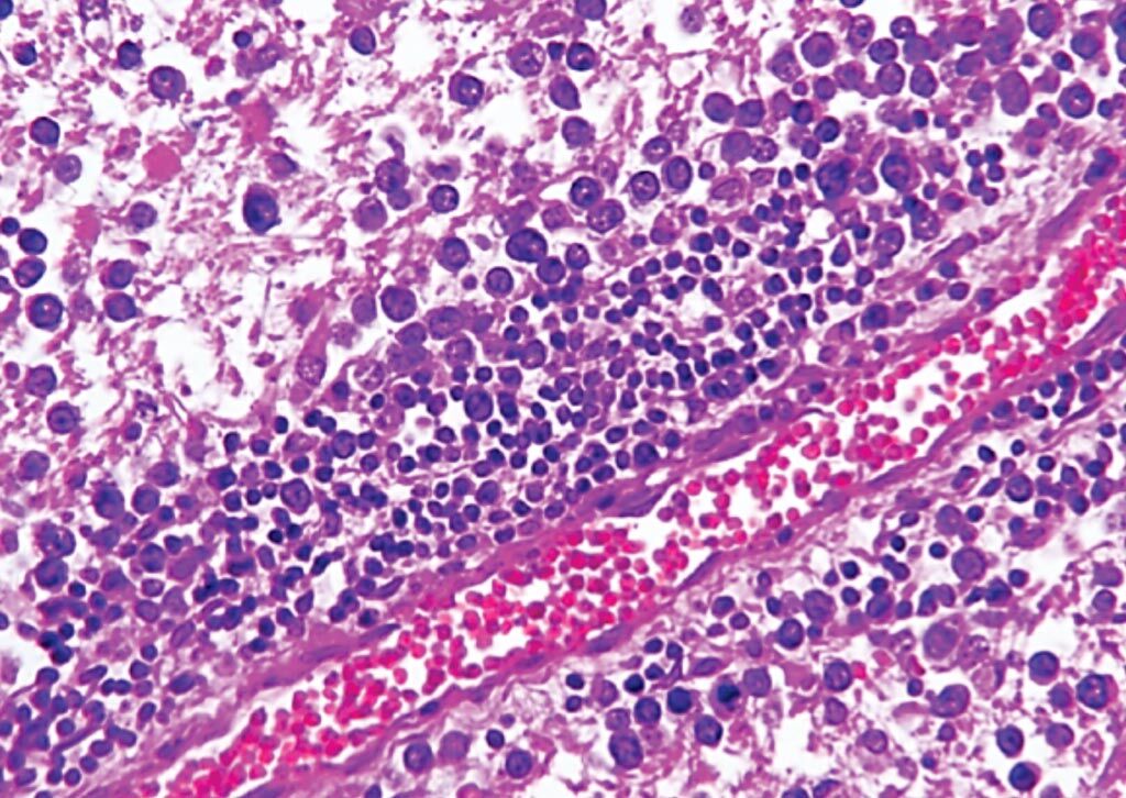 Imagen: Una histopatología del linfoma primario del sistema nervioso central que muestra pequeñas células moradas a lo largo del vaso sanguíneo en el cerebro (Fotografía cortesía del Centro Médico de la Universidad de Columbia).