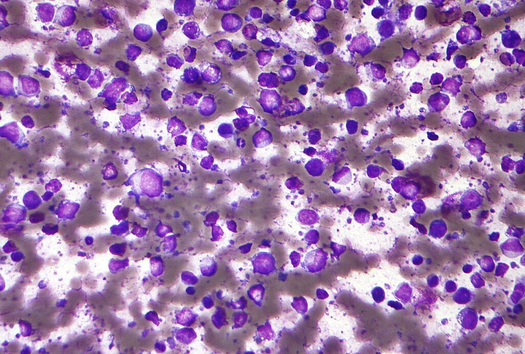 Imagen: Una micrografía de un linfoma difuso de células B grandes (DLBCL) (Fotografía cortesía de Wikimedia Commons).Los investigadores del cáncer desarrollaron una puntuación pronóstica ponderada, basada en 29 genes, para predecir la supervivencia libre de eventos y la supervivencia general de pacientes que padecen linfoma difuso de células B grandes (DLBCL).