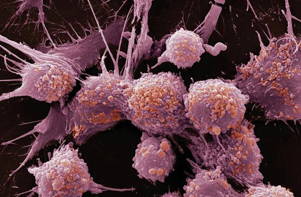 Imagen: Una micrografía electrónica de barrido (SEM) de células de cáncer de próstata (Fotografía cortesía del Instituto Sloan Kettering).