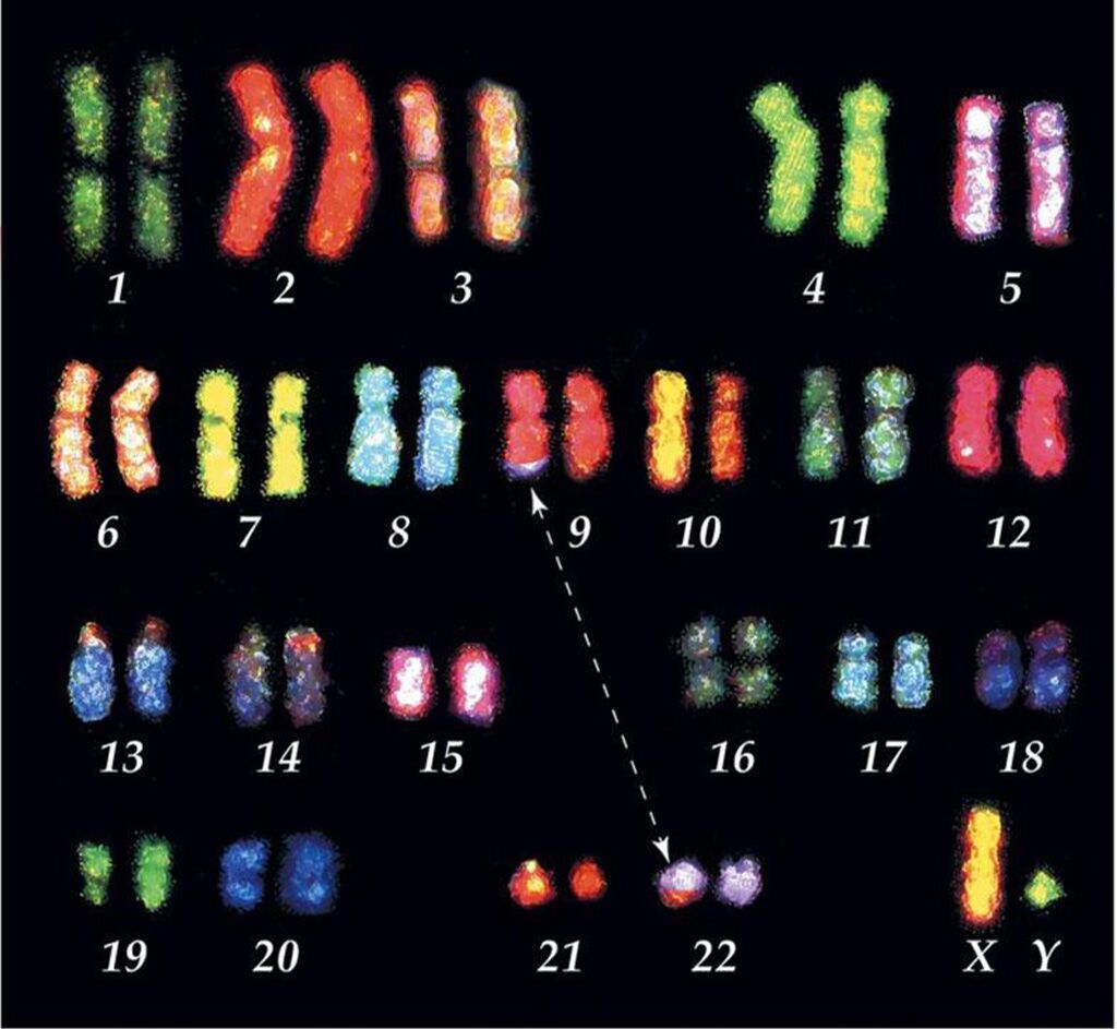 Imagen: Translocación: un fragmento de un cromosoma se mueve (“transloca”) de un cromosoma a otro y se une a un cromosoma no homólogo. El equilibrio de los genes sigue siendo normal (no se ha ganado ni perdido nada), pero puede alterar el fenotipo a medida que ubica a los genes en un nuevo entorno (Fotografía cortesía de la Universidad de Indiana).