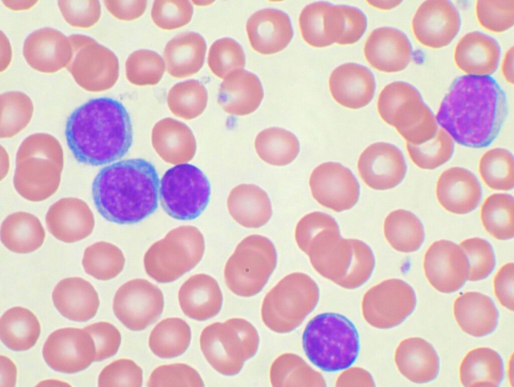 Imagen: Extendido de sangre periférica de un paciente con leucemia linfoide crónica (LLC). Los linfocitos con los núcleos de tinción oscura y el citoplasma escaso son las células de la LLC (Fotografía cortesía de VashiDonsk).