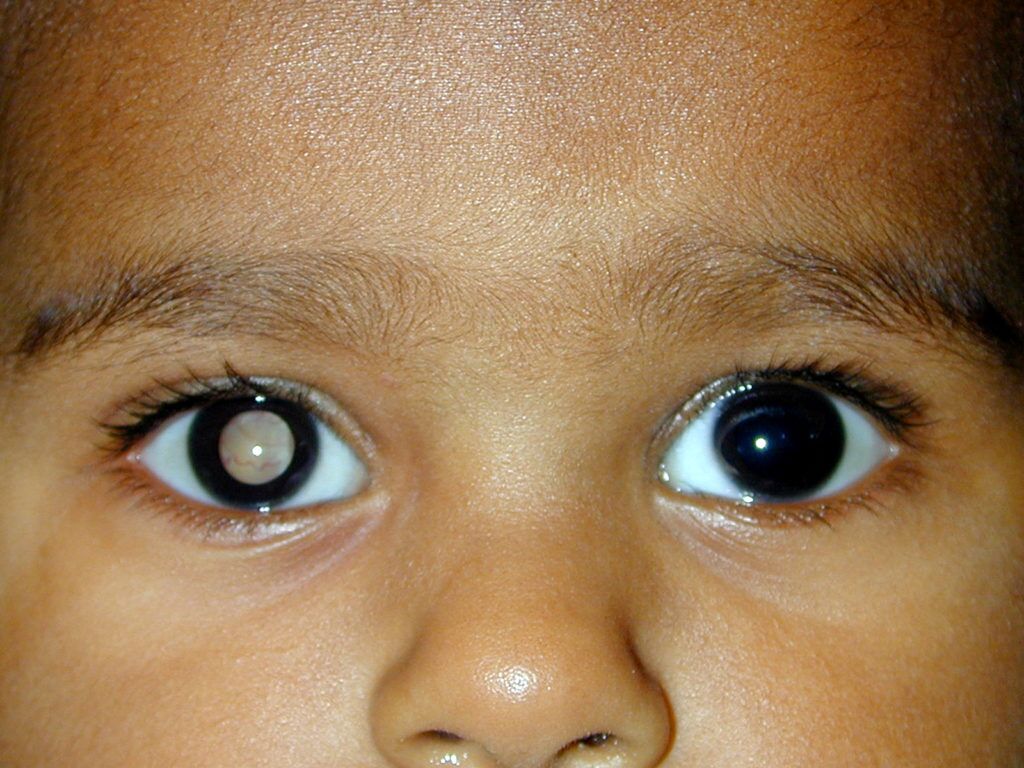 Imagen: El retinoblastoma es un cáncer del ojo del que no se puede realizar una biopsia. El humor acuoso es superior a la sangre para diagnosticar el retinoblastoma (Fotografía cortesía del Hospital Oftalmológico Aravind).