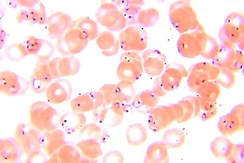 Imagen: Microfotografía de un extendido de sangre que revela la presencia de numerosos parásitos en forma de anillo de Plasmodium falciparum. Tenga en cuenta que algunos eritrocitos (glóbulos rojos) contienen múltiples parásitos. La anemia es una complicación común, y a veces, mortal de las infecciones de malaria (Fotografía cortesía de los Centros de Control y Prevención de Enfermedades/Dr. Greene).