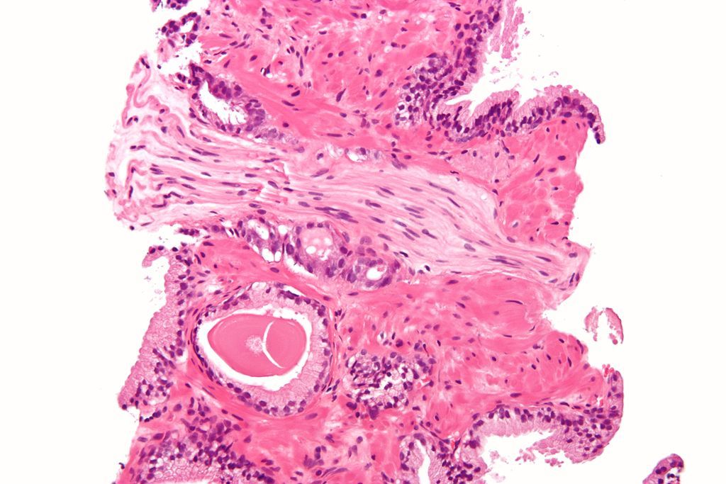Imagen: Microfotografía mostrando un cáncer de próstata (adenocarcinoma convencional) con invasión perineural (Fotografía cortesía de Wikimedia Commons)