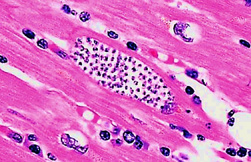 Imagen: Amastigotes de Trypanosoma cruzi en el tejido cardíaco de un paciente con enfermedad de Chagas (Fotografía cortesía de los CDC)