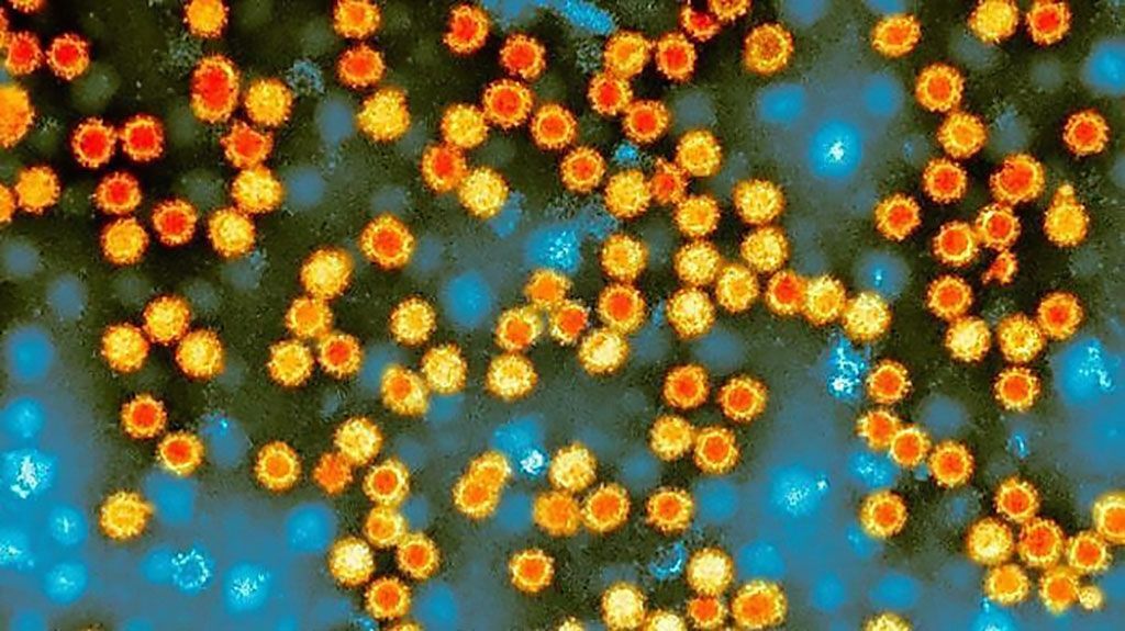 Imagen: El norovirus, que es altamente contagioso y puede sobrevivir durante días en superficies duras, infecta a 700 millones de personas en todo el mundo cada año. PCR.ai es una herramienta altamente exacta que ahorra tiempo y reduce la complejidad del análisis de qPCR para este y otros patógenos (Fotografía cortesía del Centro de Infección/Salud Pública de Inglaterra/SP).