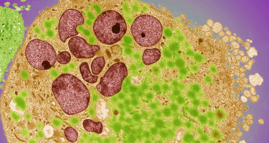 Imagen: Microfotografía electrónica de una célula de cáncer de vejiga: las pruebas de patología clínica superan a las de subtipificación molecular en el cáncer de vejiga (Fotografía cortesía de Jim Stallard).