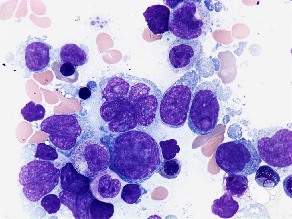 Imagen: Microfotografía de un linfoma difuso de células B grandes, de un aspirado de médula ósea; el núcleo puede estar contorneado y ser irregular (Fotografía cortesía de Peter Maslak)