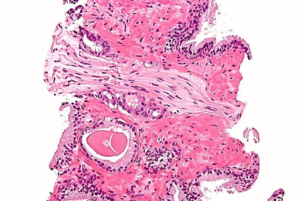 Imagen: Microfotografía de una biopsia histológica de un adenocarcinoma prostático, tipo convencional (acinar), la forma más común de cáncer de próstata (Fotografía cortesía de Nephron).
