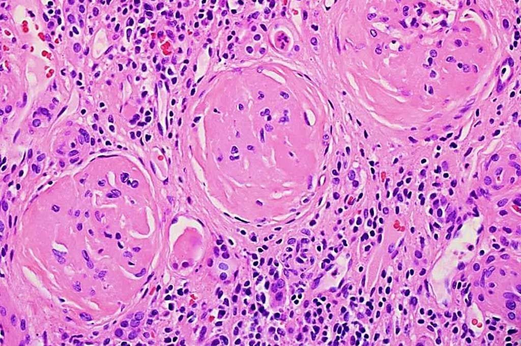 Imagen: Histopatología de la enfermedad renal: muestra glomérulos completamente escleróticos y nefritis tubulointersticial crónica grave (Fotografía cortesía de Jian-Hua Qiao, MD, FCAP).