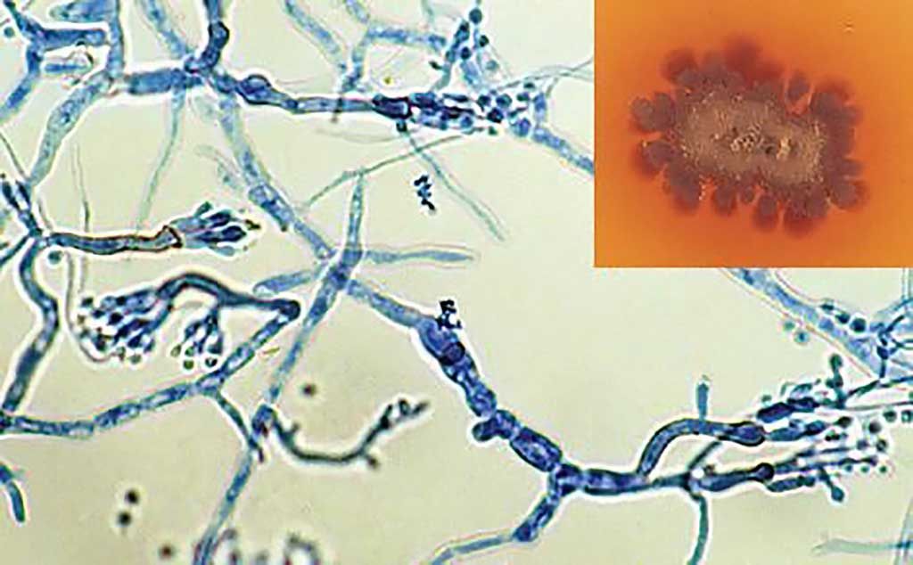 Imagen: Cultivo que muestra el pigmento marrón difuso típico en el agar (recuadro) y fiálides de Madurella mycetomatis (Fotografía cortesía de la Universidad de Adelaida).