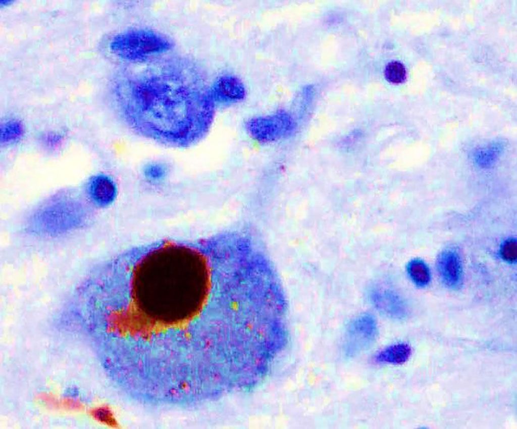 Imagen: Inmunohistoquímica para la alfa-sinucleína que muestra la coloración positiva (marrón) de un cuerpo de Lewy intraneural en la sustancia negra en la enfermedad de Parkinson (Fotografía cortesía de Marvin101).