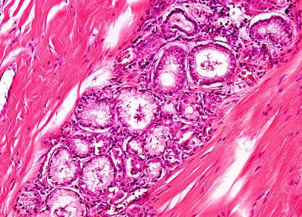 Imagen: Histopatología del adenocarcinoma de pulmón (Fotografía cortesía de Nikon).