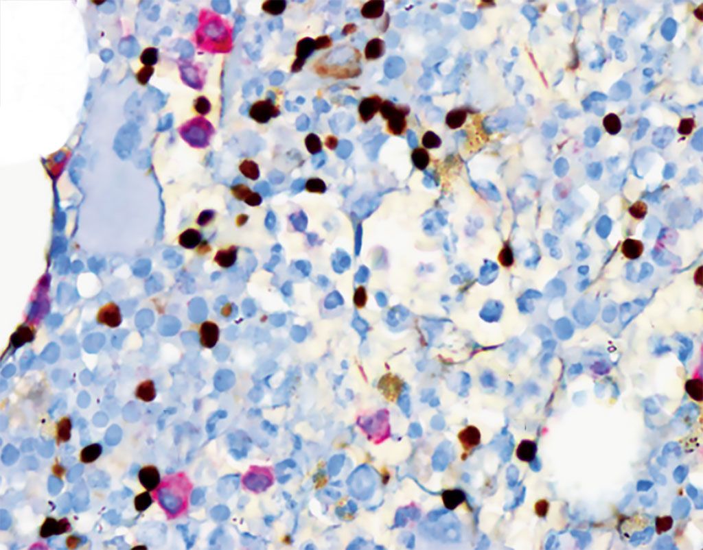 Imagen: Coloración de inmunohistoquímica dual (IHC) PAX5/CD103 que no muestra células doble positivo definitivas, coloración PAX5 que muestra tinción nuclear marrón en las células B no neoplásicas y CD103 que muestra coloración membranosa y citoplasmática en un subconjunto de células T (Fotografía cortesía del Instituto Nacional del Cáncer de los EUA) .