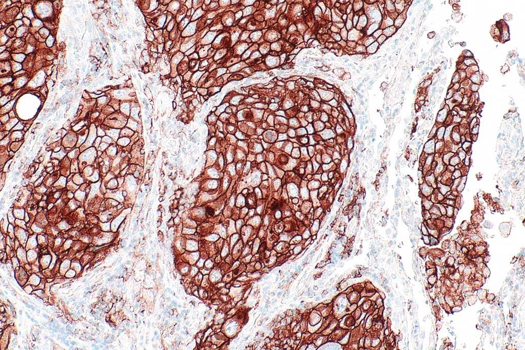 Imagen: Microfotografía inmunohistológica que muestra un carcinoma pulmonar de células no pequeñas positivo para el ligando de muerte programada 1 (PD-L1) (Fotografía cortesía de Creative Commons BY-SA 4.0/Wikimedia).