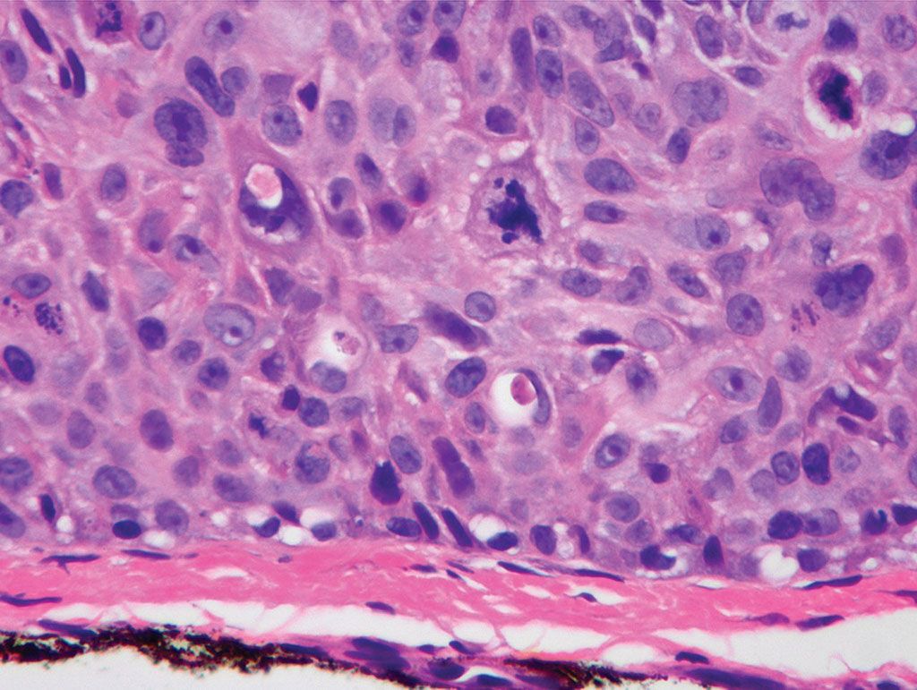 Imagen: Carcinoma escamocelular (SCC) in situ, gran aumento, que demuestra una membrana basal intacta (Fotografía cortesía de Wikimedia Commons)