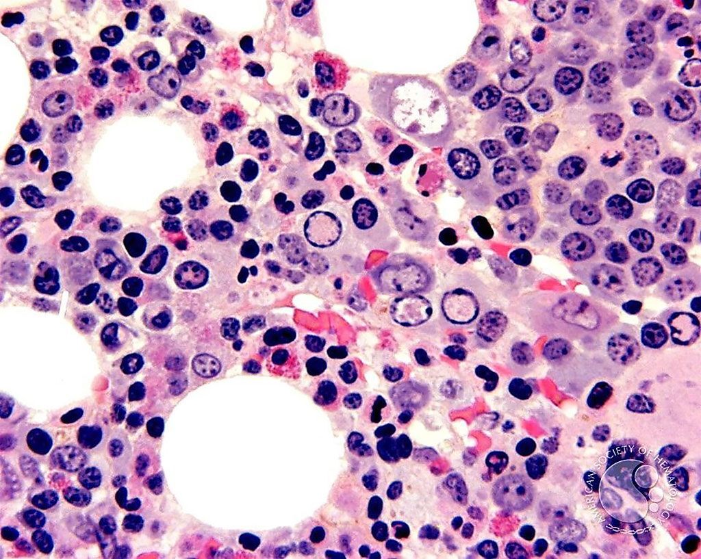Imagen: Micrografía histológica de una biopsia de médula ósea de un paciente con parvovirus. Las inclusiones nucleares de parvovirus (áreas claras) en los eritroblastos son más evidentes (Fotografía cortesía de John Lazarchick, MD).