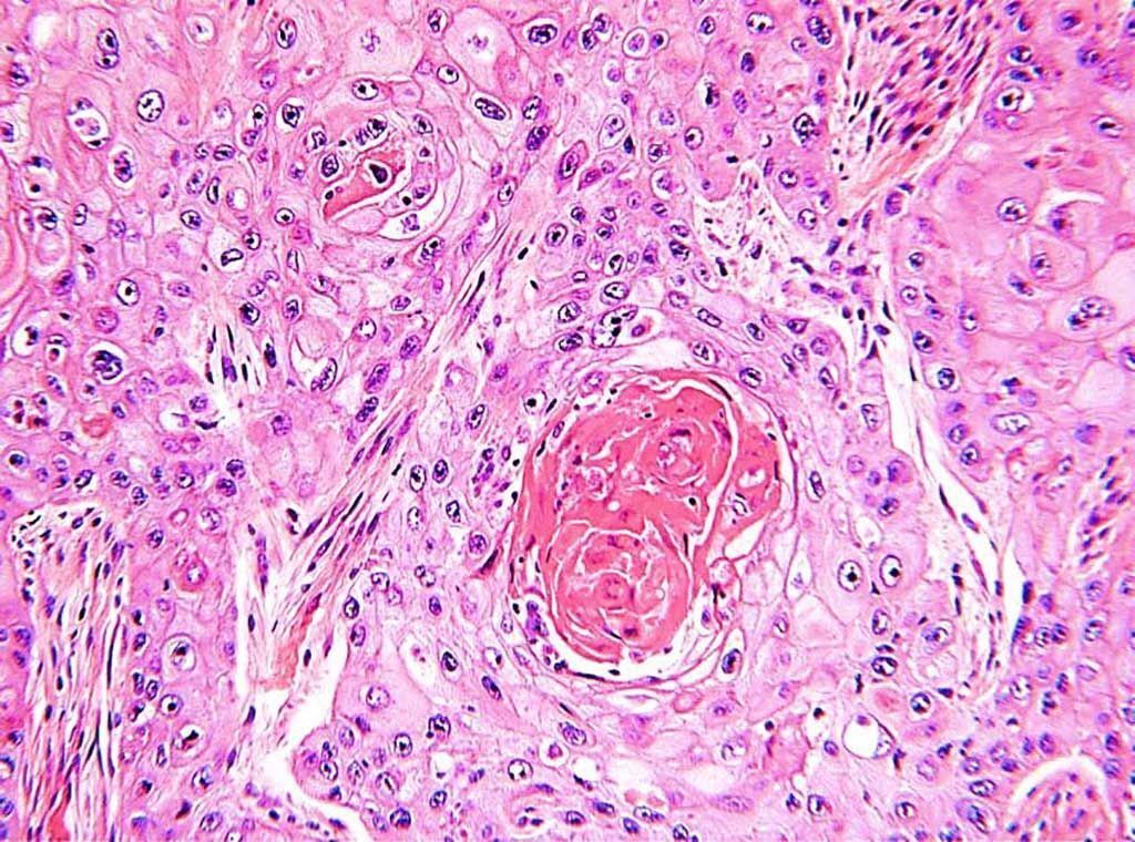 Imagen: Cortes histológicos de un carcinoma escamocelular moderadamente bien diferenciado de pulmón que muestra láminas infiltrantes y lenguas de células escamosas malignas con espirales de queratina (Fotografía cortesía del Departamento de Salud de Australia Occidental).