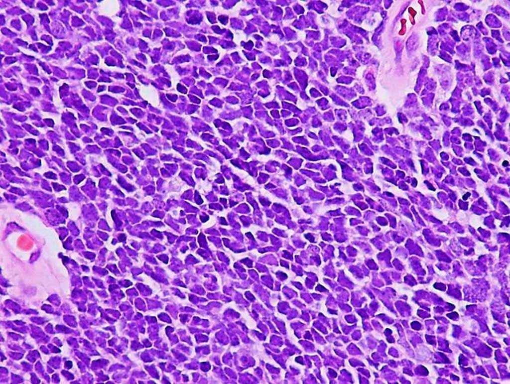 Imagen: Histopatología del meduloblastoma clásico en el cerebro que muestra un patrón difuso de crecimiento tumoral con pobre diferenciación celular, moldeo nuclear y mínimo citoplasma indistinto (Fotografía cortesía de Adekunle M. Adesina, MD, PhD)