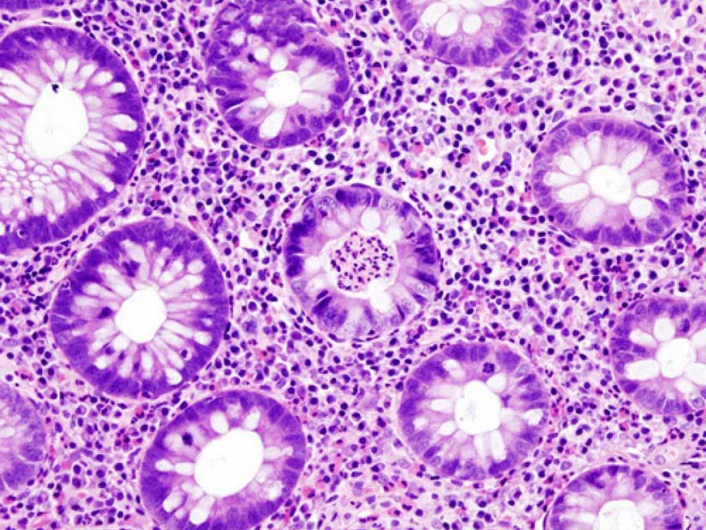 Imagen: Fotomicrografía histológica de una biopsia de colon que muestra un absceso de cripta, un hallazgo clásico en la colitis ulcerosa (Fotografía cortesía del KGH).